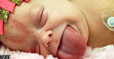 Ova beba je rođena sa jezikom odrasle osobe a nakon operacije, on je opet porastao! Evo kako izgleda danas (VIDEO)