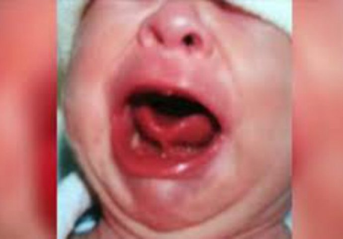 Majka je bila zabrinuta jer beba nije htjela dojiti, a onda je primijetila ovo u njenim  ustima (VIDEO)