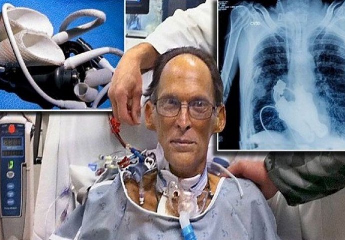 Ovo je jedan i jedini čovjek na planeti koji nema srce, on živi bez pulsa (VIDEO)