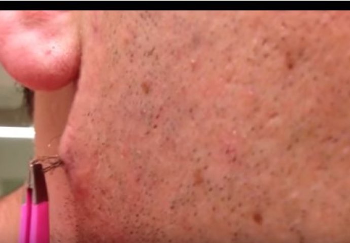 Nakon što se obrijao ugledao je uraslu dlaku:  Kad je krenuo da je vadi ostao je u šoku (VIDEO)