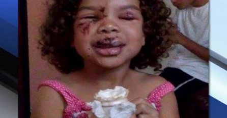 Djevojčicu je napao pas i počeo joj gristi lice: Kada je hrabri pit bull uočio šta se događa, uradio je OVO! 
