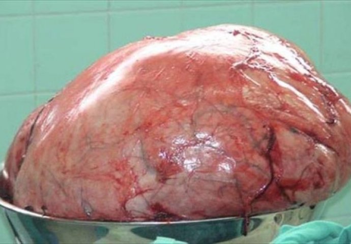 Stomak joj je težio čak 60 kg, a kada je otišla doktoru, zaprepastila se šta su pronašli (FOTO)