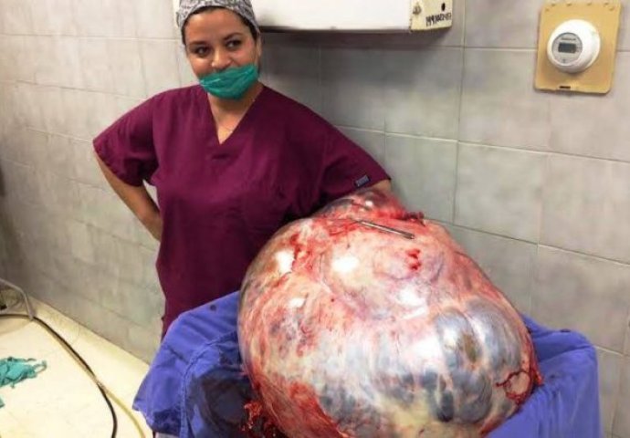 Stomak joj je težio čak 60 kg, a kada je otišla doktoru, zaprepastila se šta su pronašli (FOTO)