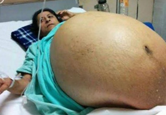 Stomak joj je težio čak 60 kg, a kada je otišla doktoru, zaprepastila se šta su pronašli (FOTO)