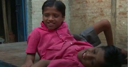 Čudesna priča sijamskih blizanaca: "Ne želimo da nas razdvoje" (VIDEO)