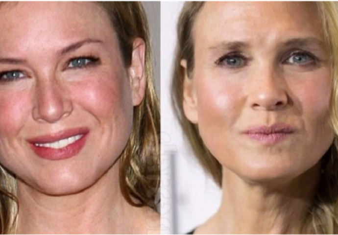 Plastične katastrofe: Slavni ovisnici koji su se potpuno upropastili!