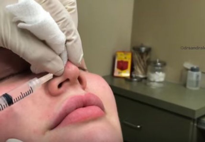Na nosu joj se pojavila bubuljica: Kada je doktorica uzela špricu počeo je pakao! (VIDEO)