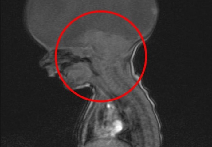 Ovaj mališan je rođen bez mozga, a ono što je uradio za svoj drugi rođendan je nevjerovatno!