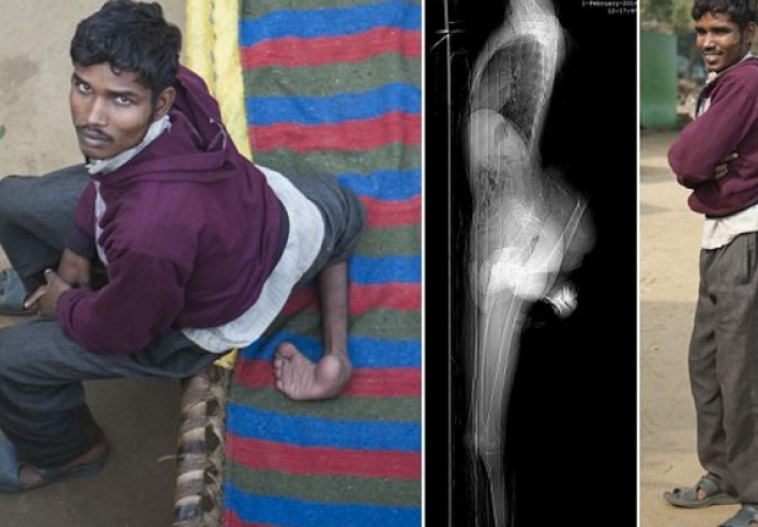 Priroda se poigrala s njim: Čovjek rođen sa četiri noge moli doktore za pomoć (VIDEO)