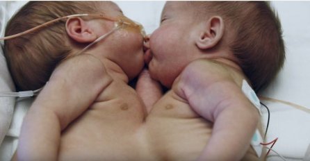 Ljekari su davali ovim sijamskim blizankama samo 5% šanse da će preživjeti: Pogledajte ih kako danas izgledaju (VIDEO)