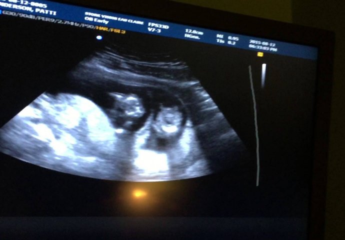 Muž je snimao njihov prvi ultrazvuk: Kada je doktorica pokazala šta se dešava u njenom stomaku, istog momenta je briznula u plač!
