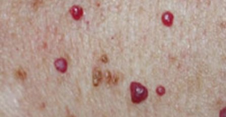 Da li imate ove crvene mrlje na različitim dijelovima tijela? Trebate li biti zabrinuti?