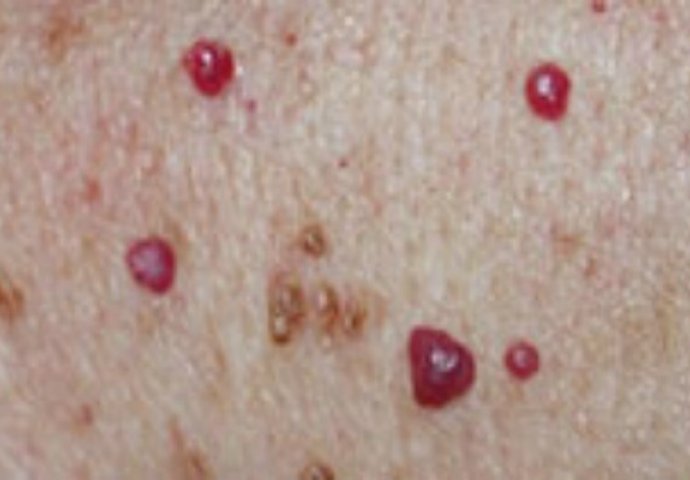 Da li imate ove crvene mrlje na različitim dijelovima tijela? Trebate li biti zabrinuti?