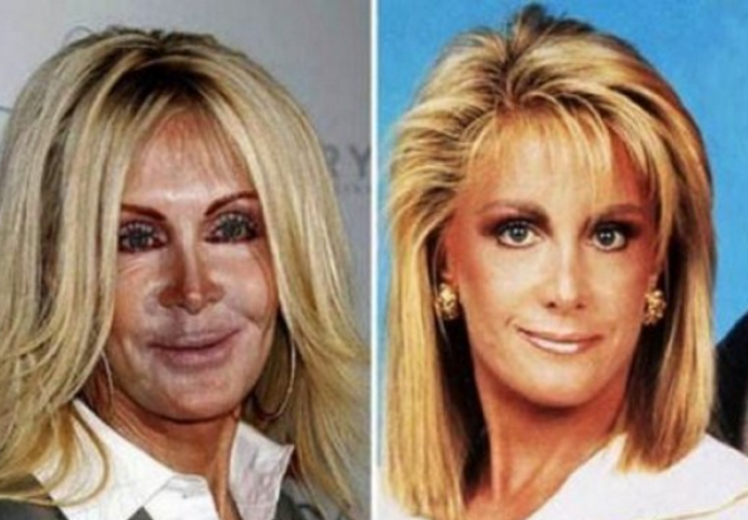 Otišli su pod nož i od sebe napravili rugobe  (FOTO)