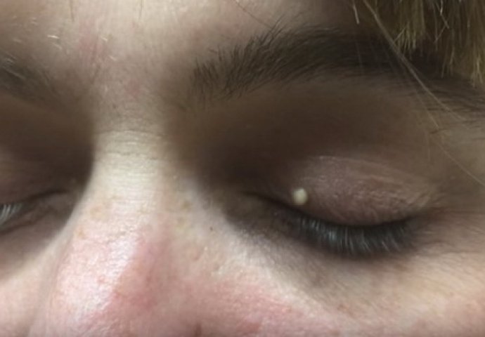 Pogledajte ako imate jak želudac: Na oku joj se pojavila bijela tačkica, a onda je doktorica uzela skalpel! (VIDEO)