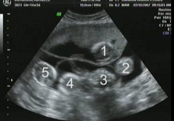 Nakon bezbroj neuspjelih pokušaja, žena je otišla na ultrazvuk, a onda doživjela šok života! 