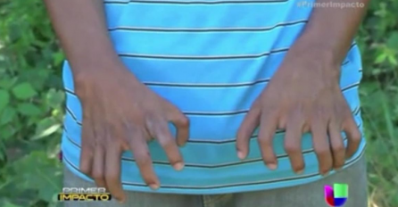  "Upirali su prstom u mene i smijali se": Dječak otkriva kako je živjeti sa 26 prsta