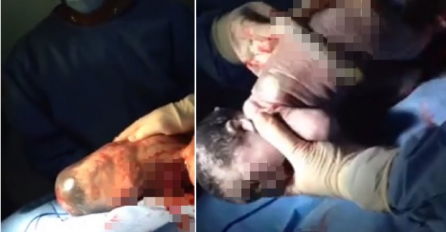 Fenomen rađanja bebe na ovaj način dešava se  jednom u 80.000 slučajeva (VIDEO)