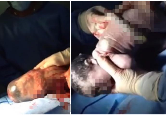 Fenomen rađanja bebe na ovaj način dešava se  jednom u 80.000 slučajeva (VIDEO)