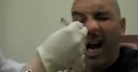 Vilica će vam pasti do poda od odvratnosti! Pogledajte šta mu je doktor izvadio iz nosa (VIDEO)