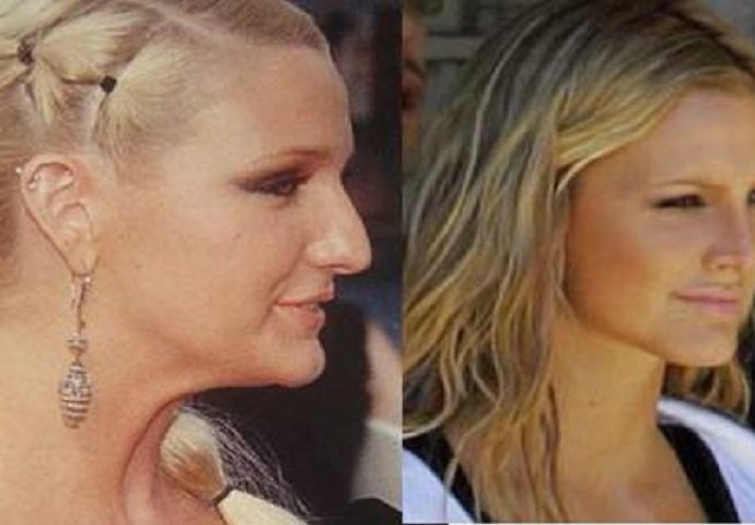  Ove poznate ličnosti prije plastičnih operacija nisu ličile ni na šta, a sada izgledaju fenomenalno 