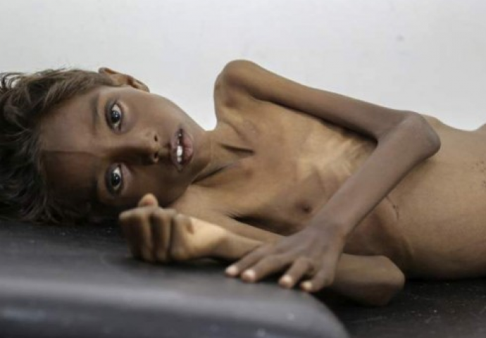 I glad ima svoje lice: Nad ovom djecom se nadvila smrt, a niko ništa ne poduzima da se to spriječi (UZNEMIRUJUĆI FOTO)