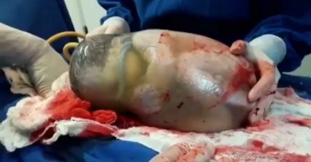 Liječnici snimili izuzetno rijedak prizor: Beba se rodila u netaknutoj amnionskoj vrećici (VIDEO)