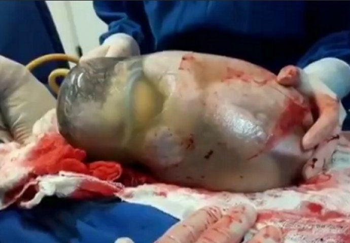 Liječnici snimili izuzetno rijedak prizor: Beba se rodila u netaknutoj amnionskoj vrećici (VIDEO)
