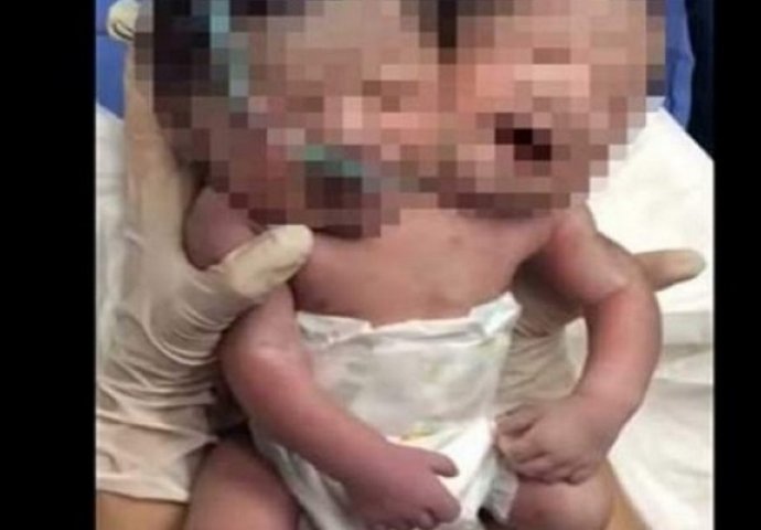 Svijet u šoku: Rodila dječaka sa dvije glave (VIDEO)