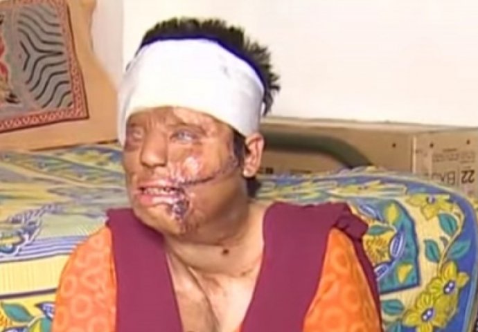 Tinejdžerku su napala 3 muškarca i posuli joj kiselinu na lice: 10 godina kasnije, ona izgleda ovako!