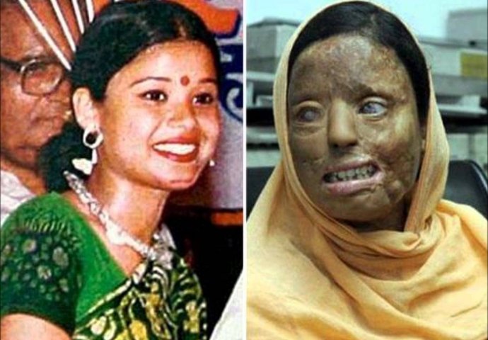 Tinejdžerku su napala 3 muškarca i posuli joj kiselinu na lice: 10 godina kasnije, ona izgleda ovako!