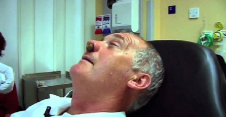 Ovaj izmučeni čovjek pokazao je doktoru svoj nos, ono što je izvukao je nevjerovatno (VIDEO)