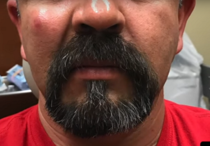 Izgledalo je kao da ga je ujeo komarac, a nije ni slutio kakva grozota mu je bila pod kožom (VIDEO)