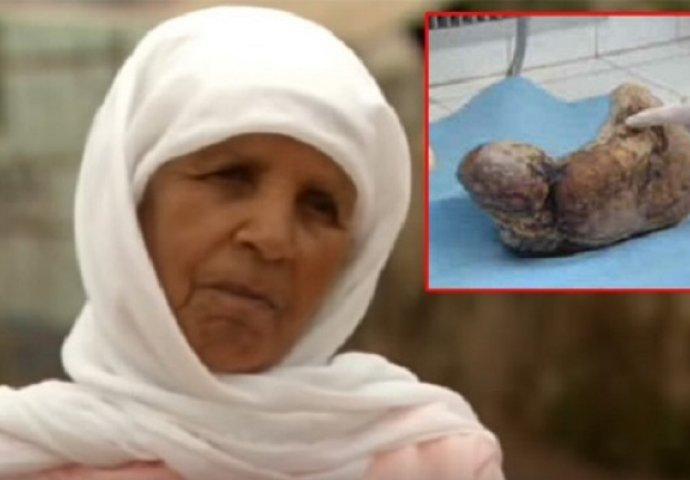 Žena bila trudna 46 godina, rodila kameno dijete (VIDEO)