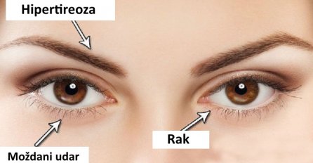  NIJE ZA IGRU: Bilo koja od ovih promjena na vašim očima može da znači da vaš organizam razara neka od ovih teških bolesti!