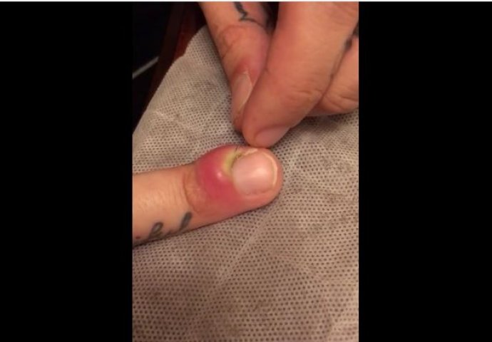 Imao je GROZNU infekciju na svom prstu: Uzeo je iglu, a onda je nastao pravi HOROR! (VIDEO)