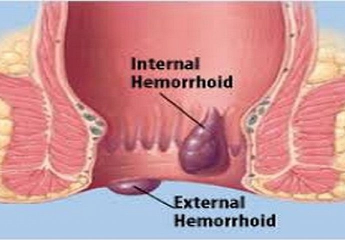 Riješite se hemoroida zauvijek! Recept domaće masti za liječenje hemoroida