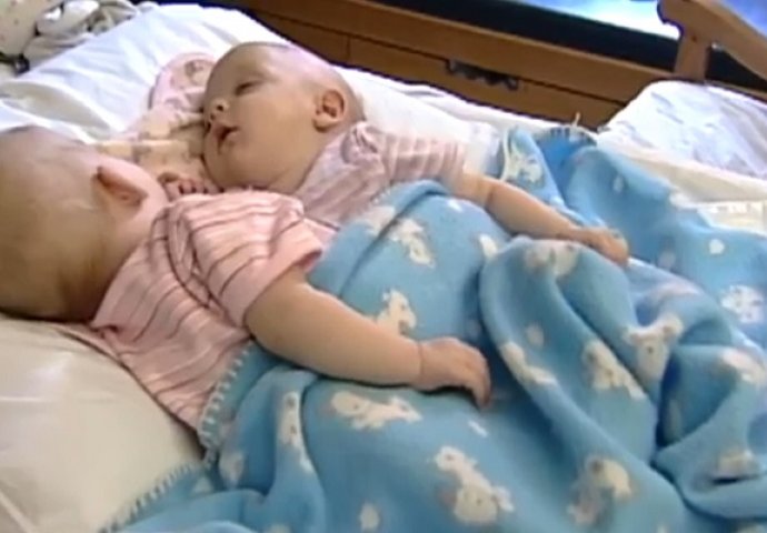 Majka je rodila spojene blizankinje: 10 godina kasnije, izgledaju totalno drugačije (VIDEO)