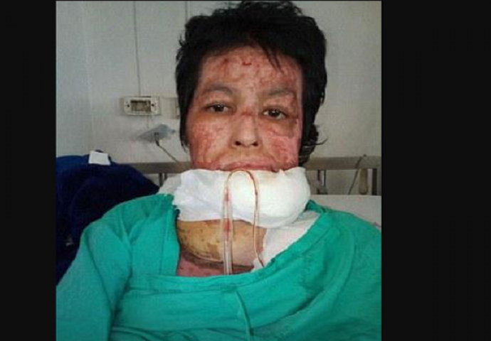 Muž je polio benzinom i zapalio a ona mu sve oprašta! Čekajte da pročitate razlog zašto je to uradio (FOTO)
