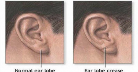 Ako imate ovo na resici uha, onda je vrlo moguće da vam otkazuje najbitniji organ  u tijelu