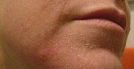 Ako vam se koža na licu guli, to nije znak da se obnavlja, nego je u pitanju nešto mnogo ozbiljnije
