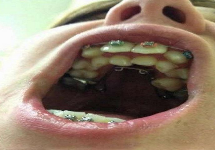 Dječaku uklonili 232 zuba, operacija trajala 7 sati, a ovo nije jedini slučaj bizarnog tumora!