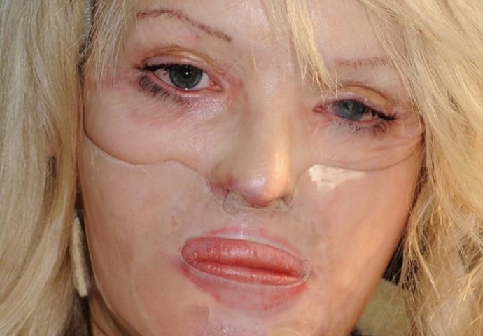 NEKADA JE BILA LJEPOTICA: Prije devet godina dečko joj je KISELINOM unakazio lice, evo kako izgleda nakon 100 OPERACIJA! (UZNEMIRUJUĆI SADRŽAJ)