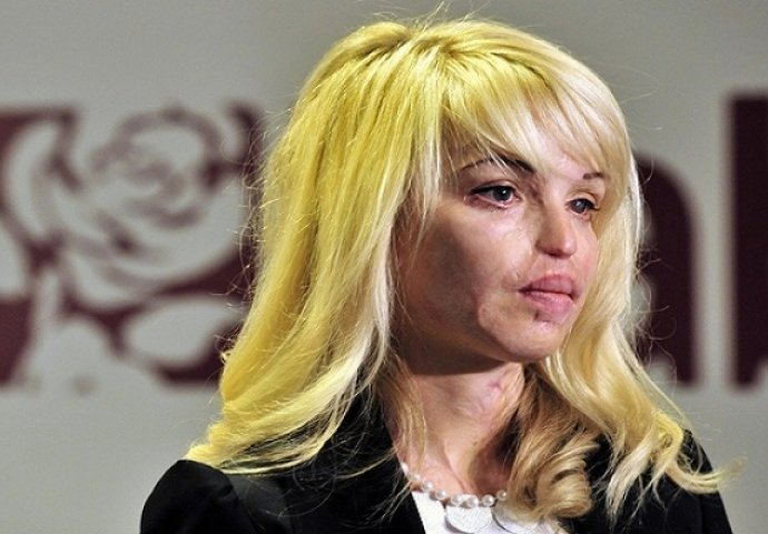 Prije 9 godina dečko joj je sipao kiselinu u lice, a danas izgleda ovako!