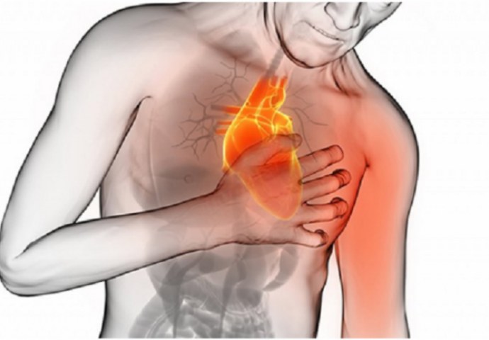 Akutni infarkt miokarda (SRČANI UDAR)