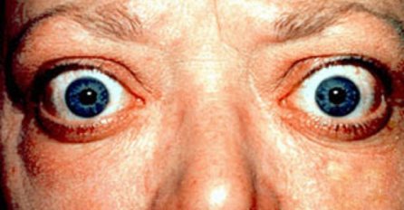 OBRATITE PAŽNJU: 10 znakova da imate problema sa štitnjačom!