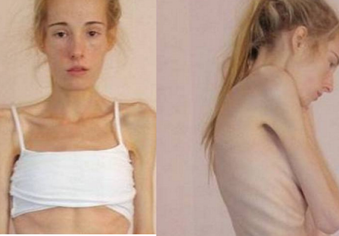 Ljekari su joj dali još sam dva dana života! Anoreksija je do na korak do smrti samo zato jer se smatrala debelom (VIDEO)