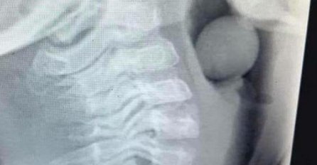  Šokantna rendgenska snimka pokazuje što je dijete progutalo