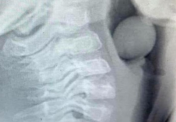  Šokantna rendgenska snimka pokazuje što je dijete progutalo