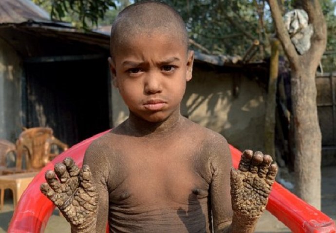 Osmogodišnji dječak ima rijetku bolest koja ga "pretvara u kamen", samo pričekajte da vidite kako sada izgleda (VIDEO)